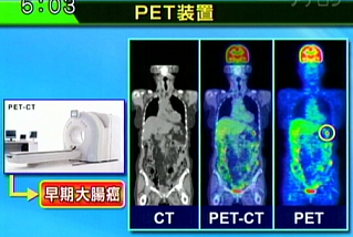 医師が示した早期大腸癌（○枠内）