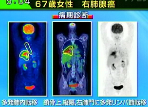 医師が示した早期大腸癌（○枠内）