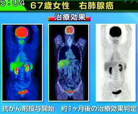 抗がん剤投与１ケ月後