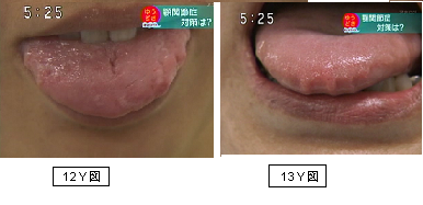 舌に歯形が付く