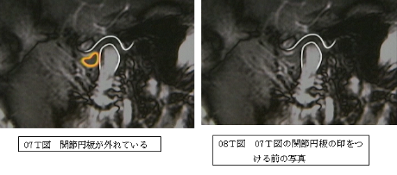 関節円板がずれたという説明図