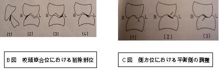 咬頭嵌合位における削除部位