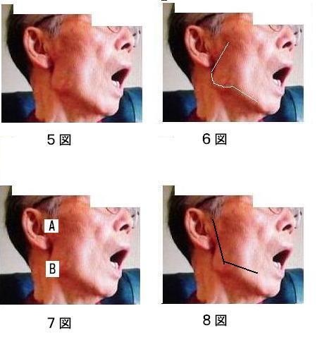 下顎偏位の修正