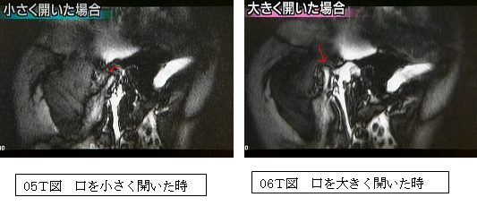 口を開いたときの状態