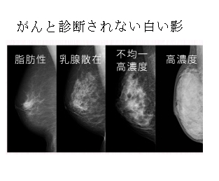 高濃度乳房